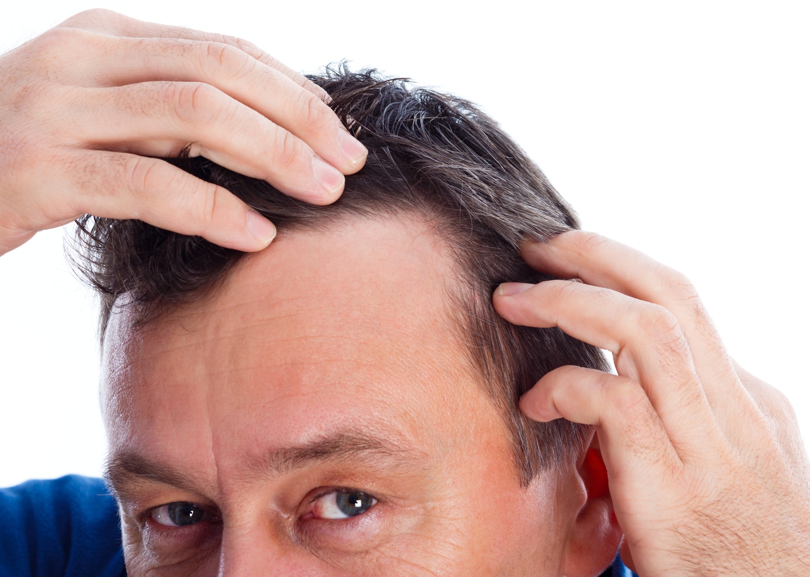 Middle age man suffering from androgenic hair loss.